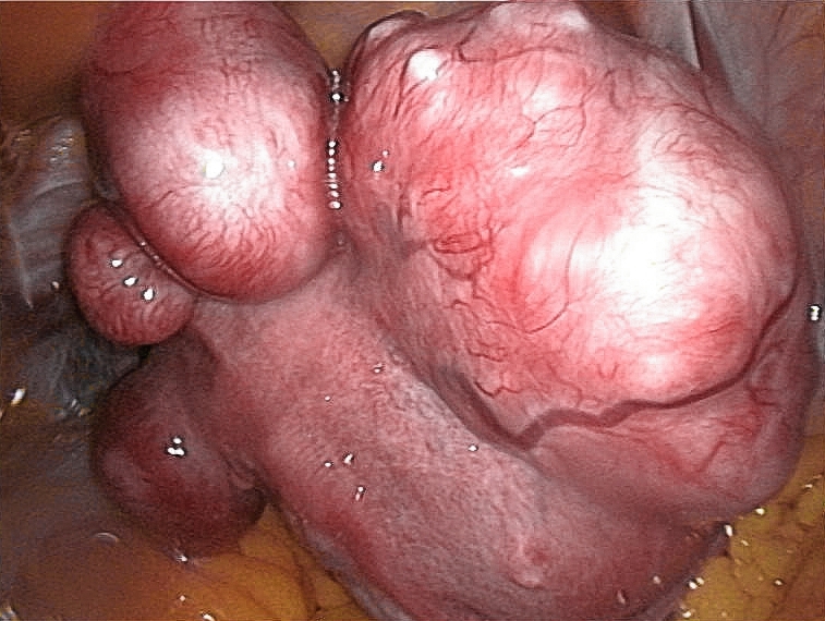 Leiomyom Uterus (Laparaskopie)